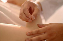 针灸减肥正当宠